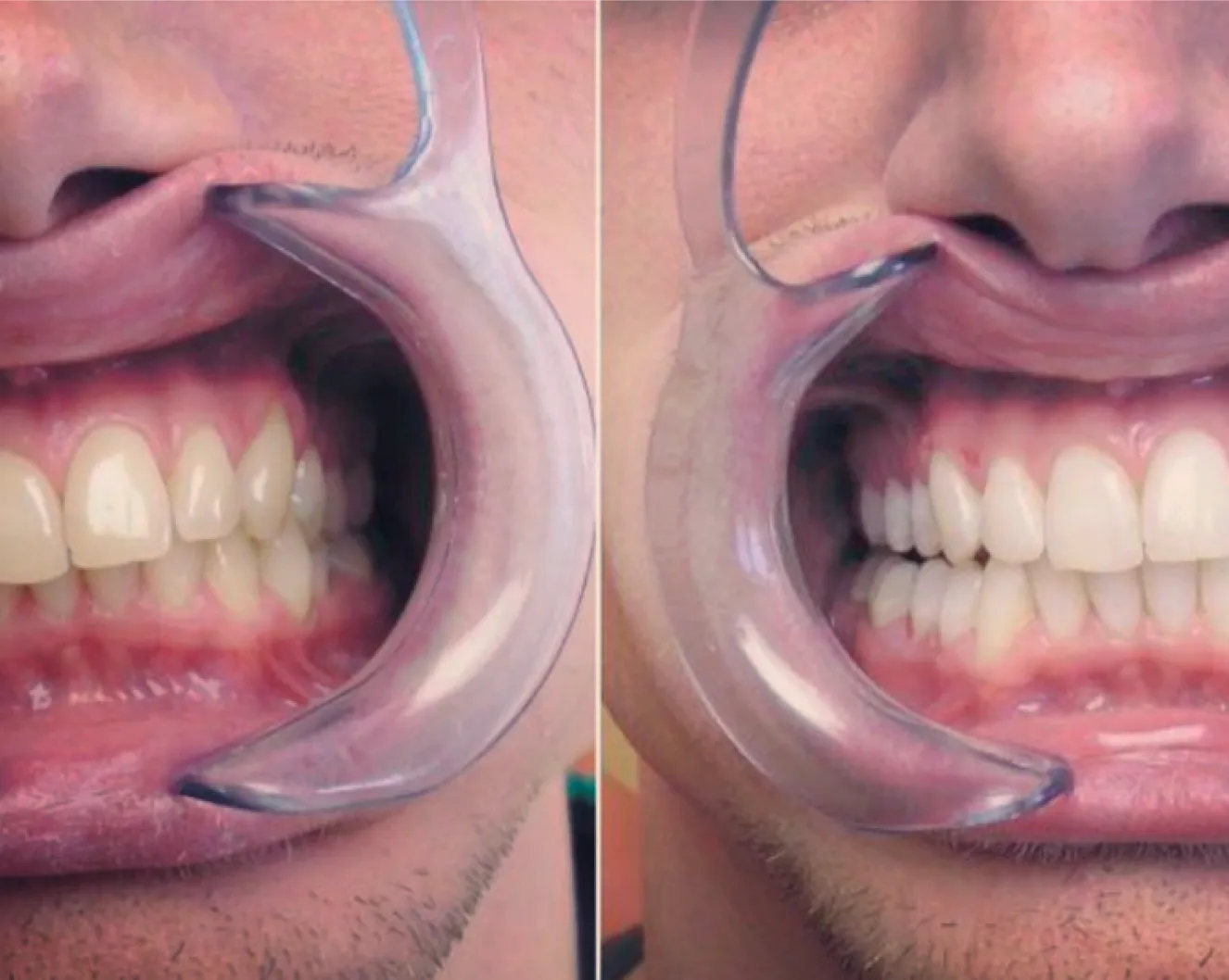 bielenie-zubov-dental-brothers-32