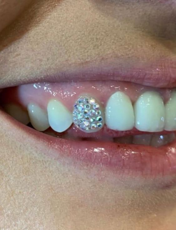 Šperk na zub