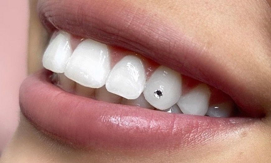 Šperk na zub