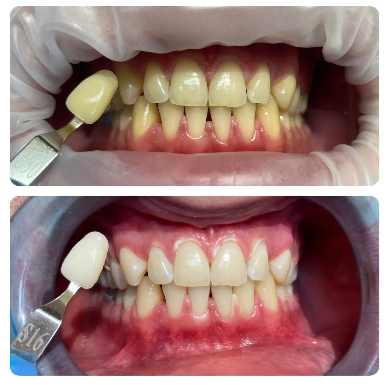 Ambulantné bielenie zubov