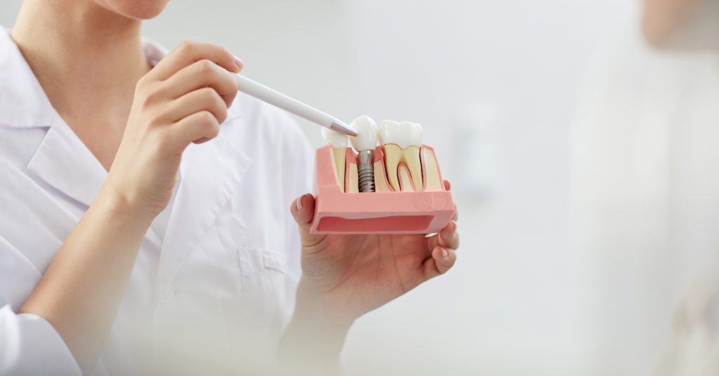 zubné implantáty maketa