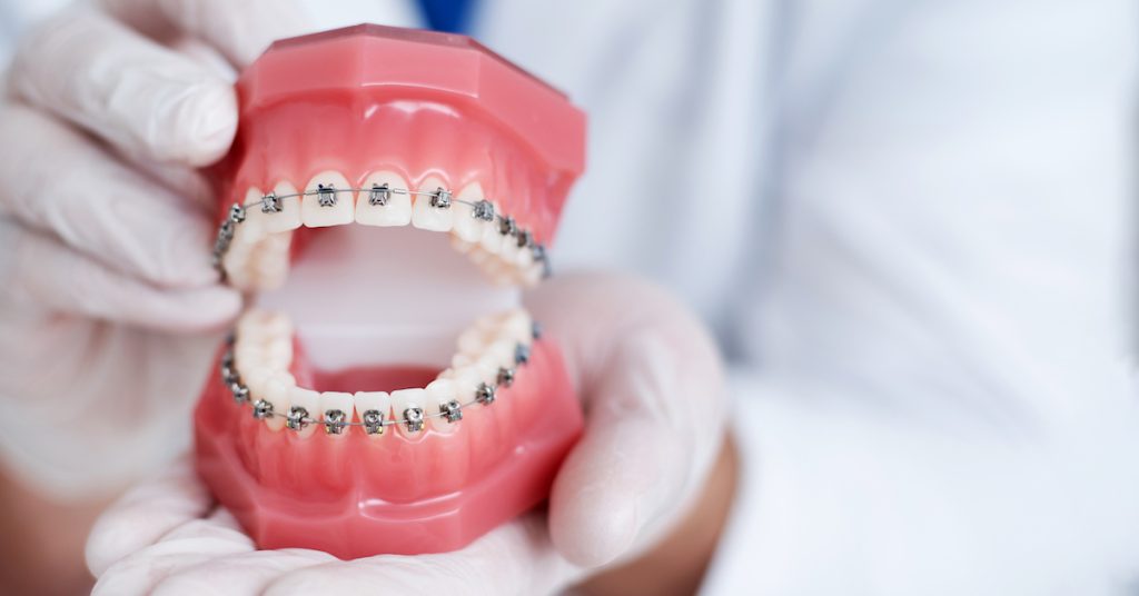 dentálna hygiena zubov s fixnym aparatom