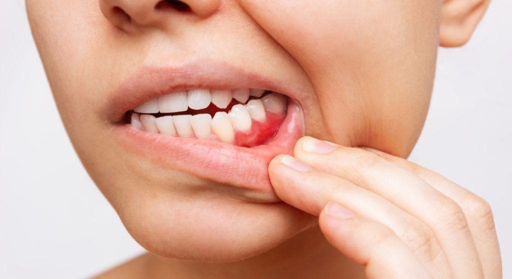 obnažené zubné krčky