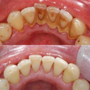 Dentálna hygiena - pred a po