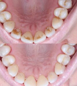 Dentálna hygiena - pred a po